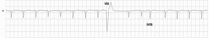 VEB Left Bundle Branch Morphology Rhythm Strip